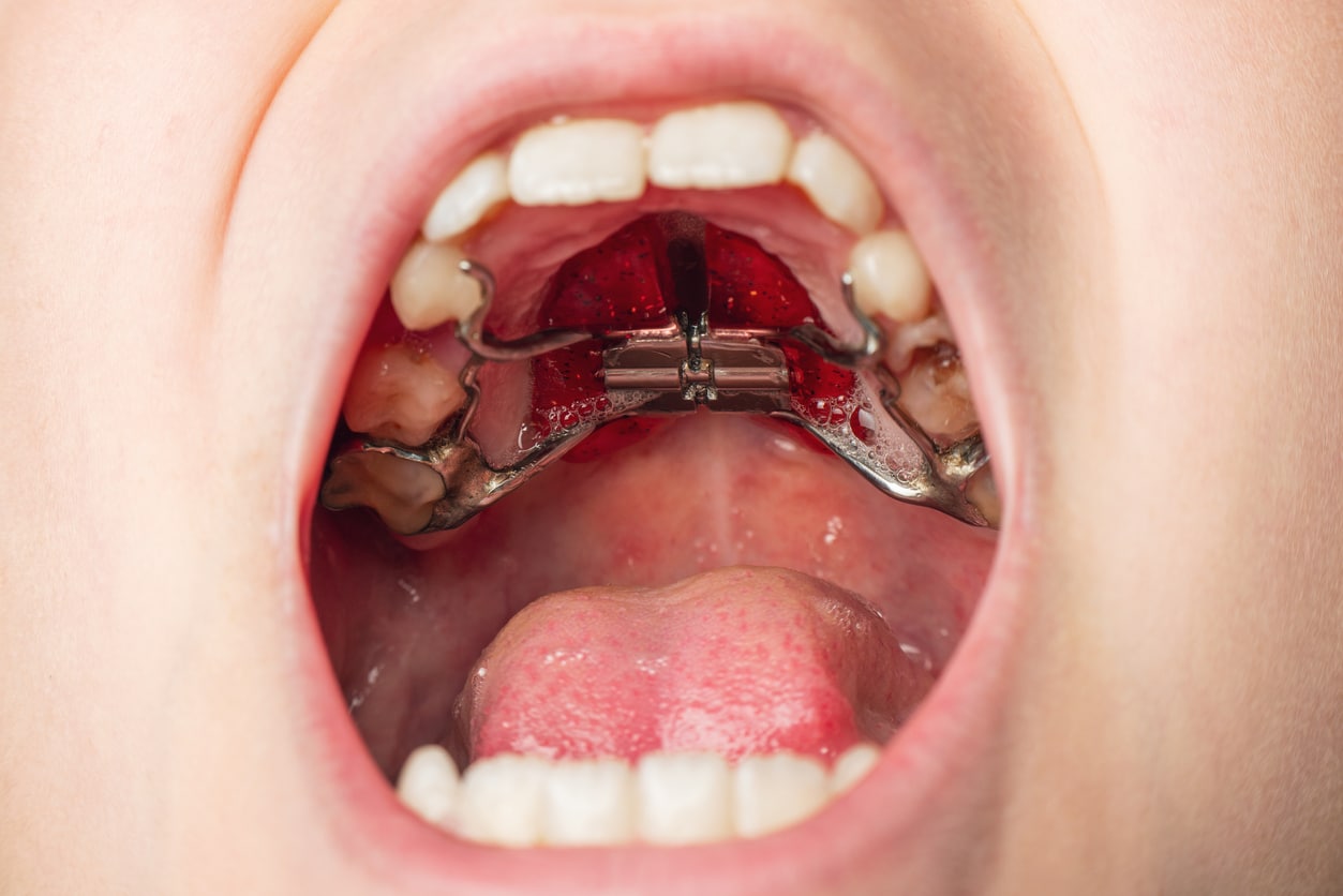 Palatal expander orthodontic appliance for bite and jaw correction at Dr. B Smiles Orthodontics in Wappingers Falls, NY